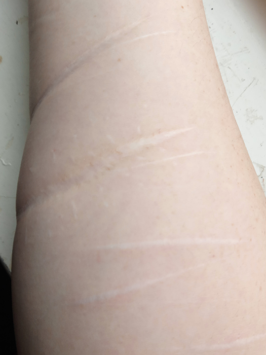 My BPD Scars